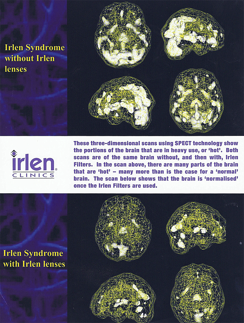 Brain Scan showing results of wearing and not wearing glasses